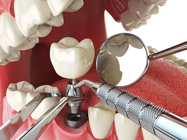 Best Knocked-Out Tooth (Avulsed Tooth) Treatment in Creedmoor, NC